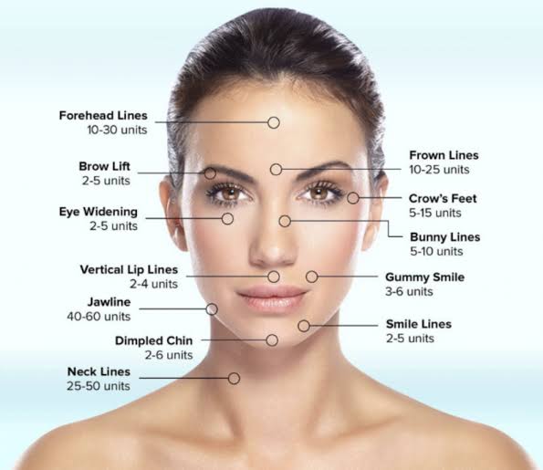 Schéma des indications de la toxine botulique : plis d'amertume, sourire gingival et menton - Metz