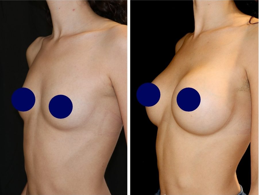 Photo Augmentation mammaire avant après, résultat naturel avec prothèses ergonomiques - Dr de Runz Metz