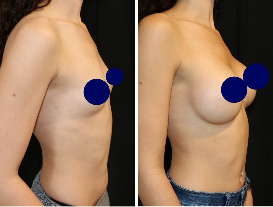 Chirurgie esthétique mammaire avant après, prothèses ergonomiques pour un résultat souple - Dr de Runz