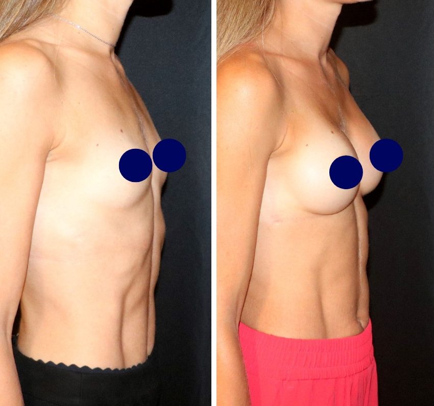 Chirurgie des seins avant après, augmentation mammaire par prothèses - Dr Antoine de Runz
