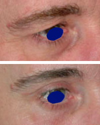 Cicatrice de blépharoplastie supérieure avant après, zoom sur le pli palpébral - Metz