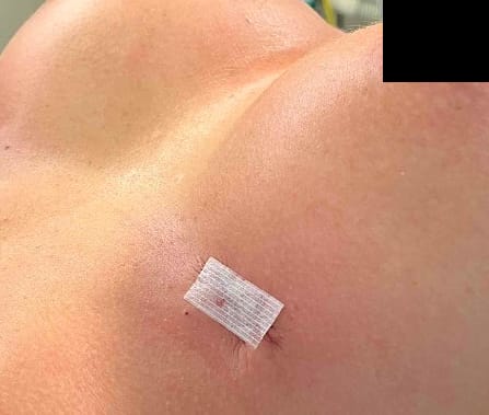 Cicatrice sous-mammaire après augmentation des seins par prothèses - Metz