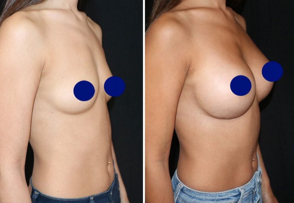 Photos d'implants mammaires avant après, pour correction de la poitrine - Metz