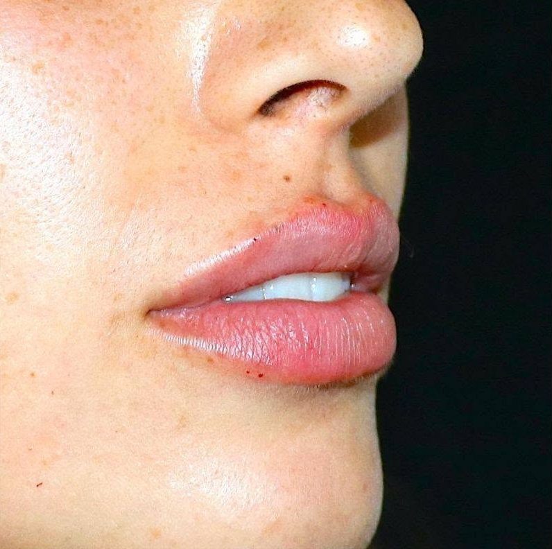 Injection des lèvres à l'acide hyaluronique pour repulpage naturel à Metz — Dr de Runz