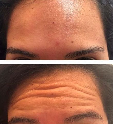 Injections de toxine botulique avant après, lissage des rides du front - Dr de Runz Metz