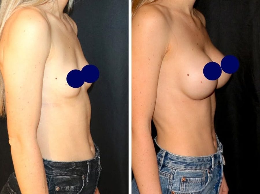 Mammoplastie d'augmentation avant après, harmonie de la silhouette et de la poitrine - Metz