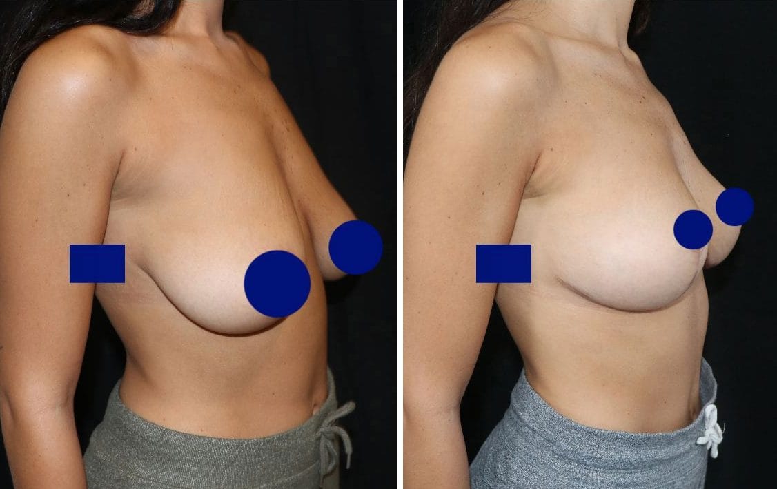 lifting des seins avant après, chirurgie de la ptôse mammaire - Dr de Runz Metz