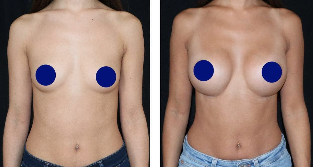 Photo Augmentation mammaire par implants avant après, pose sous-musculaire ou devant le muscle - Metz