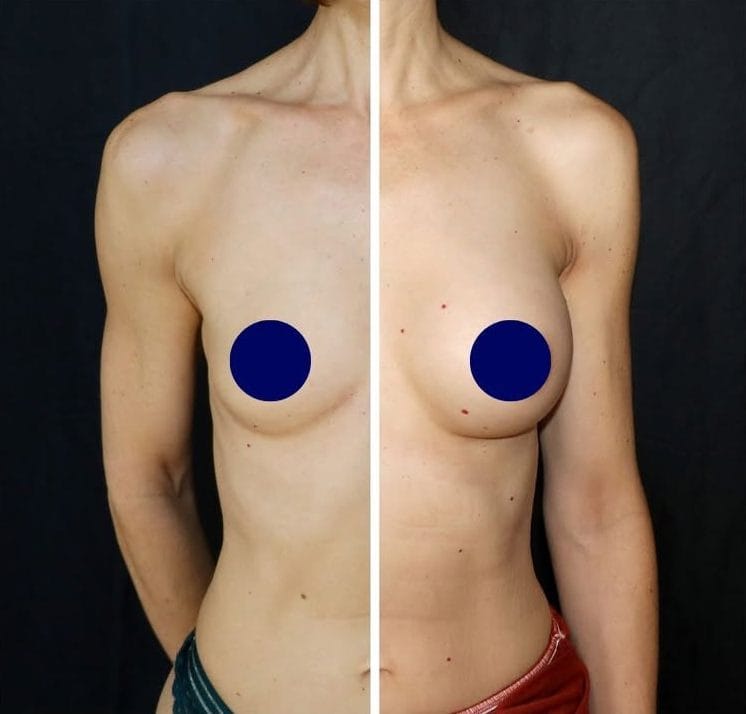 Correction d'hypotrophie mammaire avant après, augmentation de volume par chirurgie plastique - Metz