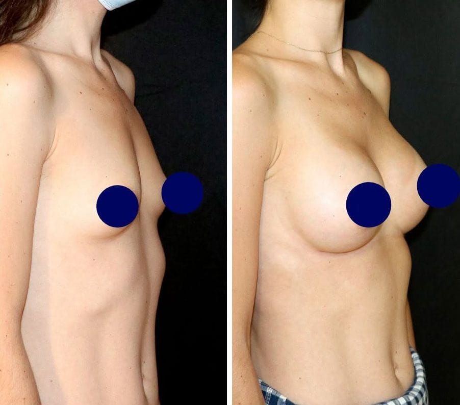 Photos Chirurgie esthétique des seins avant après, pose de prothèses mammaires en gel de silicone - Dr de Runz