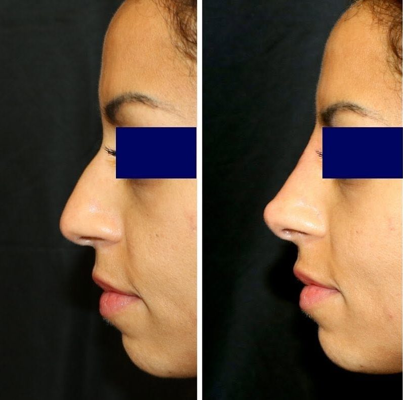 Rhinoplastie médicale avant après, correction d'une bosse du nez par injection d'acide hyaluronique - Dr de Runz Metz