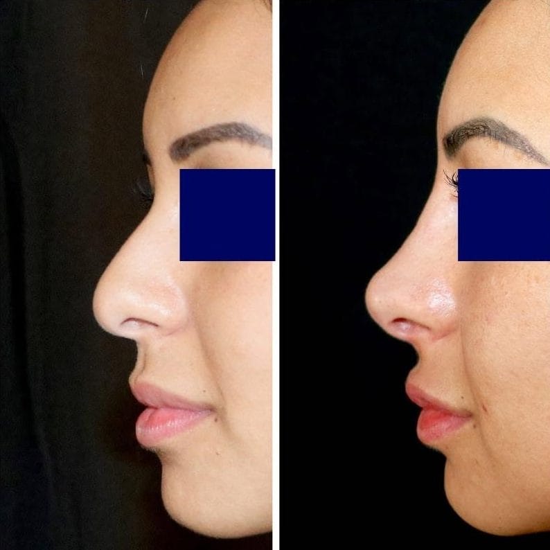 Rhinoplastie sans chirurgie avant après, correction de la bosse du nez par injection - Metz