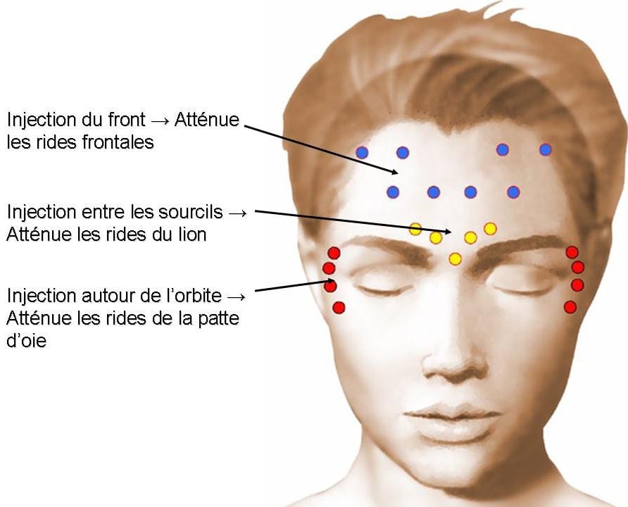 Schéma des zones d'injection de Botox au visage : rides du front, du lion et patte d'oie - Metz