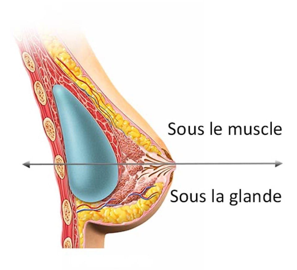 Schéma de l'augmentation mammaire en Dual-plane : pose de prothèse sous le muscle et sous la glande - Metz